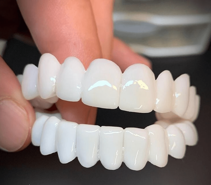 Natural-Look Dental Veneer for Everyday Confidence
