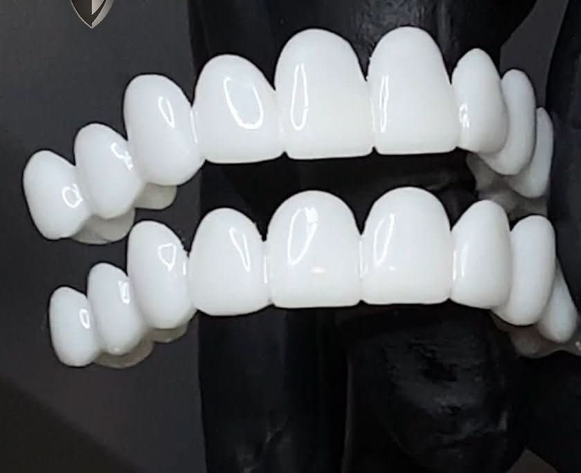 Natural-Look Dental Veneer for Everyday Confidence